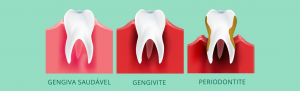 dç periodontal